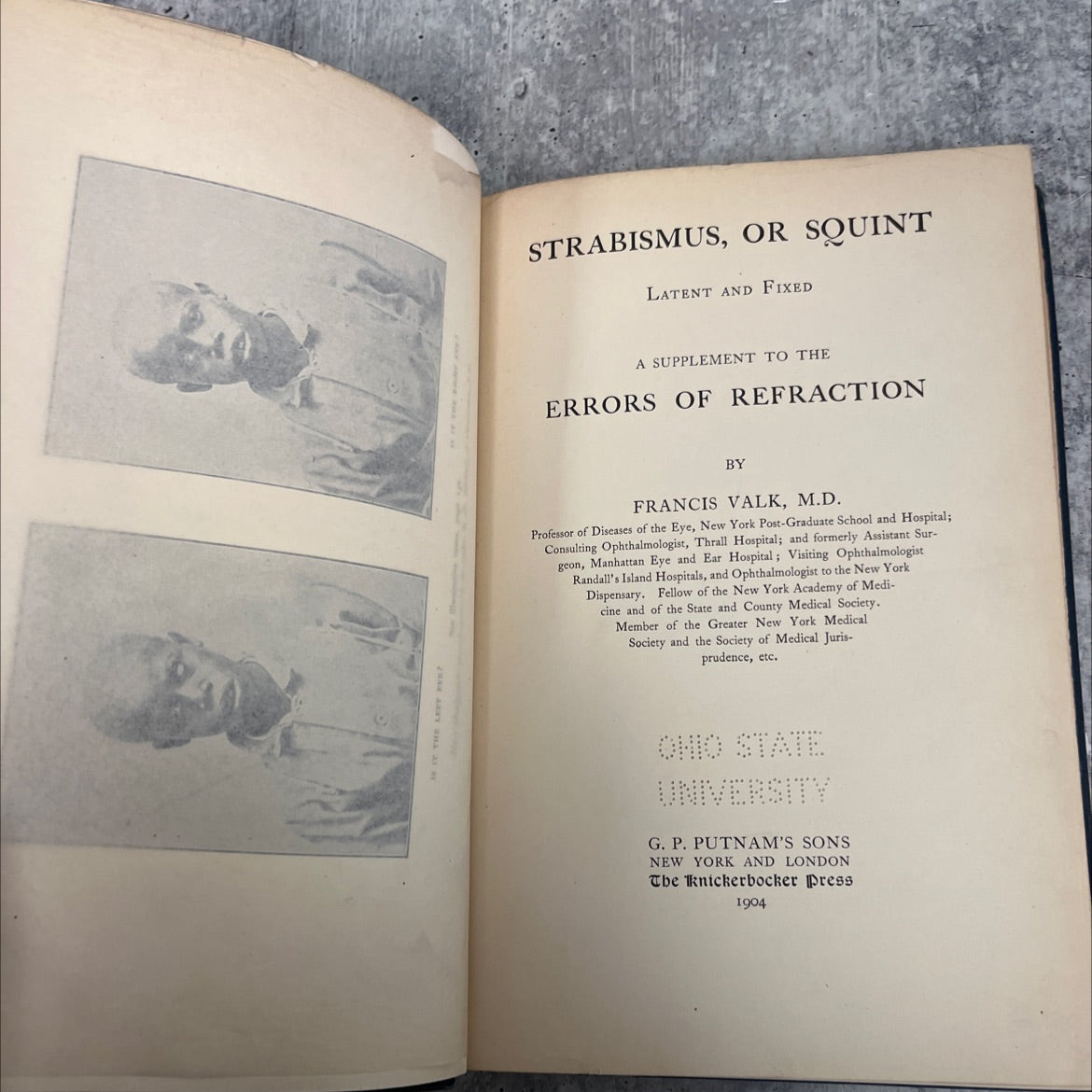 strabismus, or squint latent and fixed a supplement to the errors of refraction book, by francis valk, m.d., 1904 image 2
